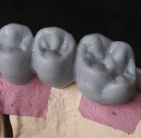 Ceramill CAD/CAM 在植体臨床上的運用圖片(另開新視窗)